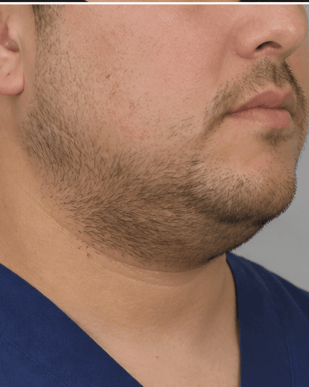 Submental Fat Dissolving: before