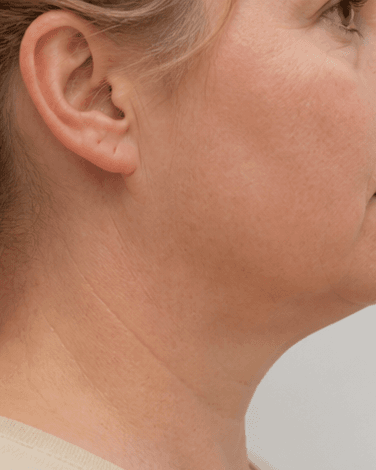 Double Chin Reduction: after