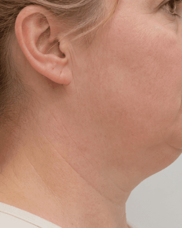 Double Chin Reduction: before