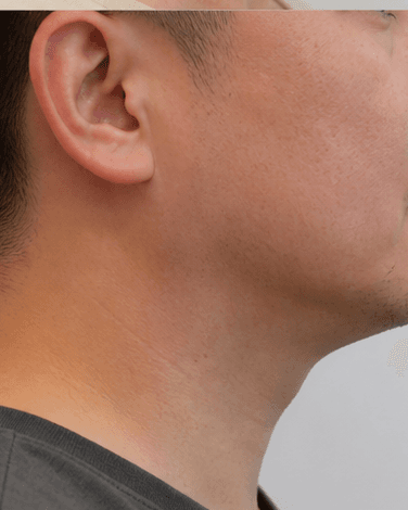 Double Chin Reduction: after