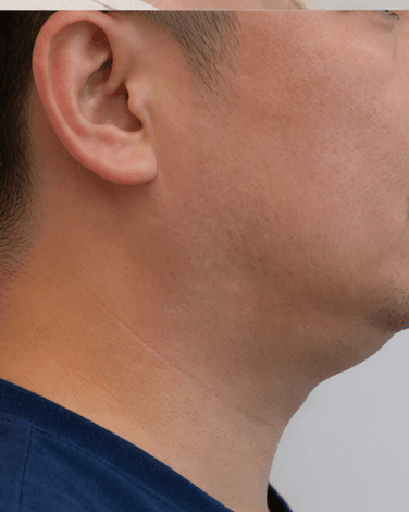 Double Chin Reduction: before