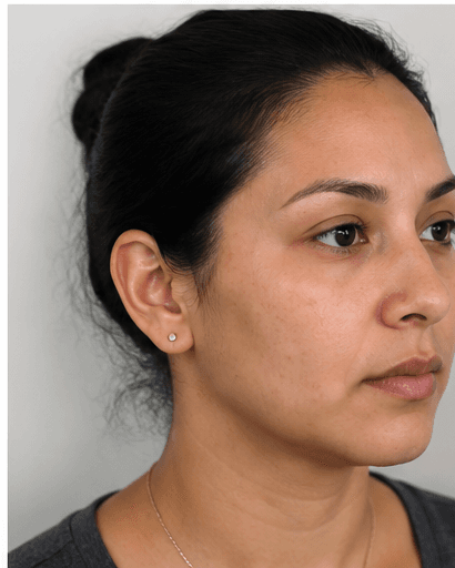 Full Facial Balancing: before