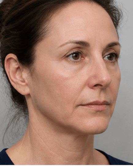 Facial Fat Transfer: after