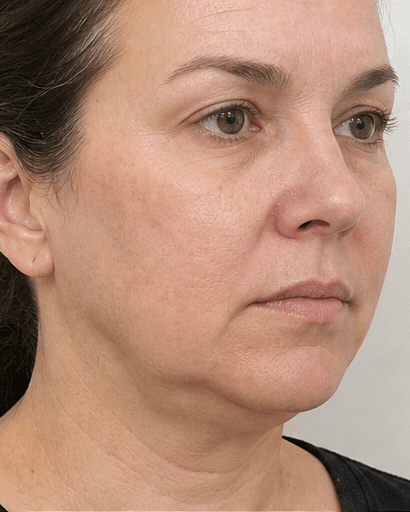 Facial Slimming HIFU: before
