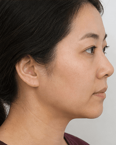 Facial Slimming HIFU: after