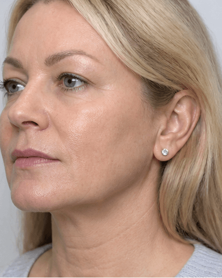 Jaw Slimming Programme: after