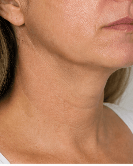 Neck Contouring: after