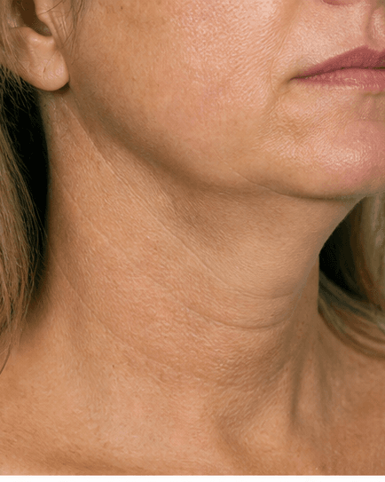 Neck Contouring: before