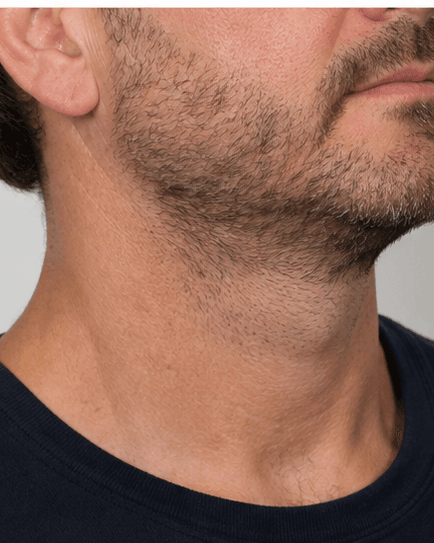 Neck Contouring: after