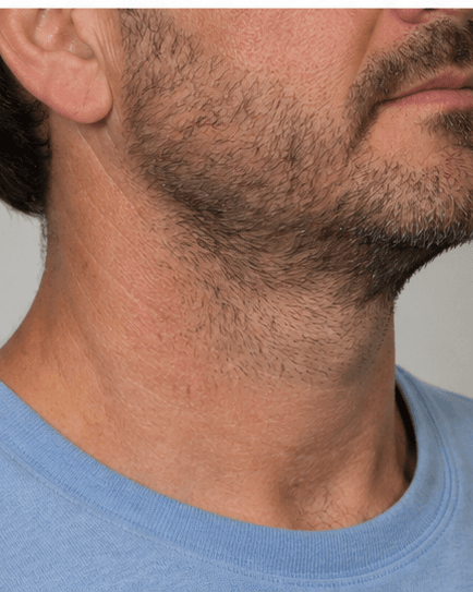 Neck Contouring: before
