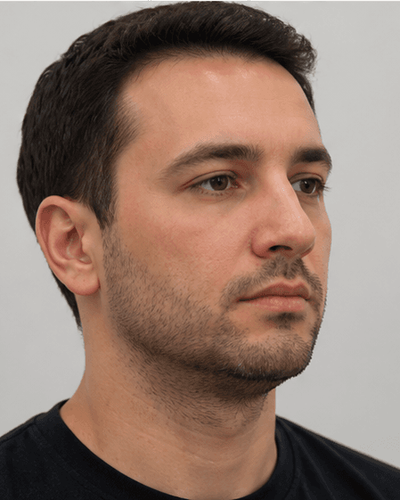 V-Line Contouring: before