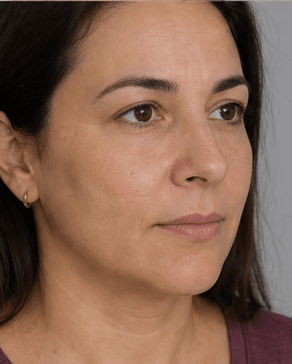 Cheek Augmentation: before