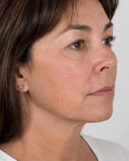 Chin Projection: after