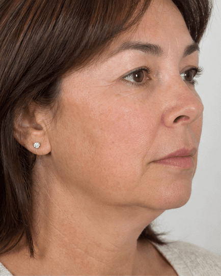 Chin Projection: before