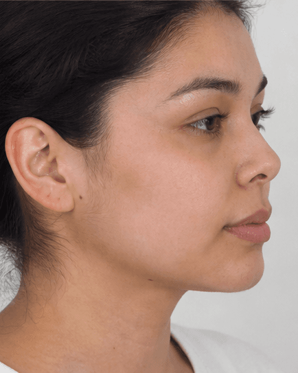 Chin Projection: after