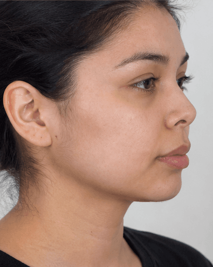 Chin Projection: before