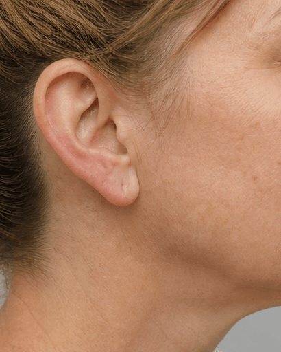 Earlobe Restoration: after