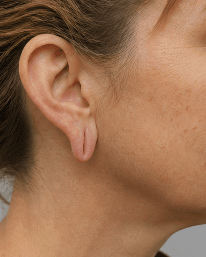Earlobe Restoration: before