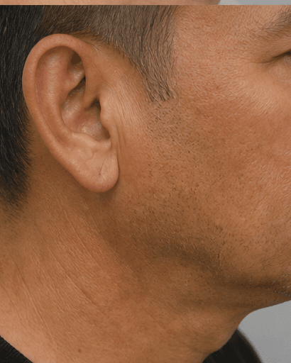 Earlobe Restoration: after