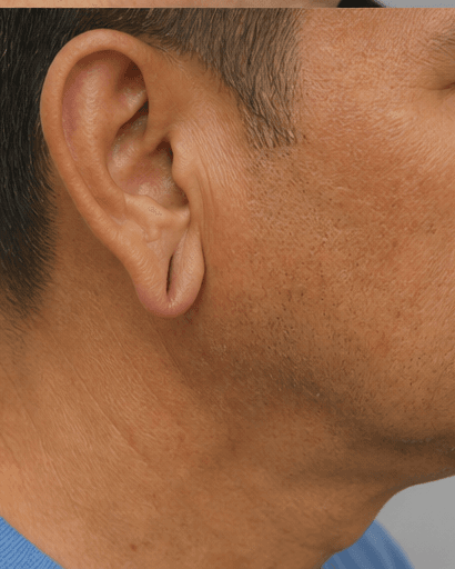 Earlobe Restoration: before