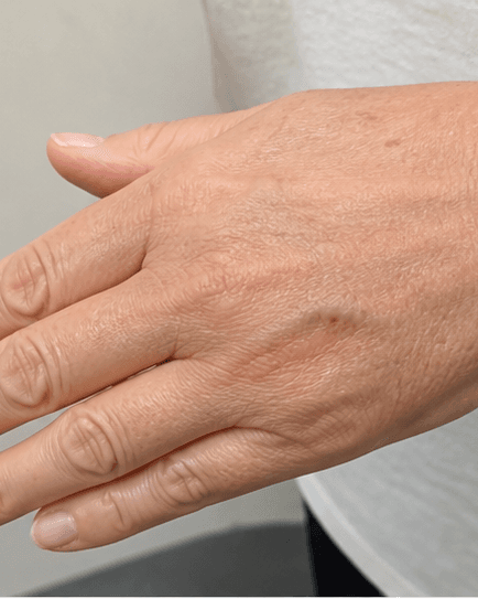 Hand Rejuvenation: after