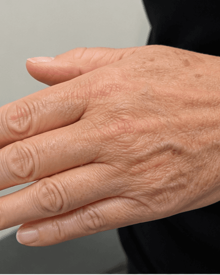 Hand Rejuvenation: before