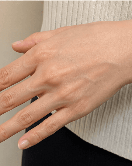 Hand Rejuvenation: after