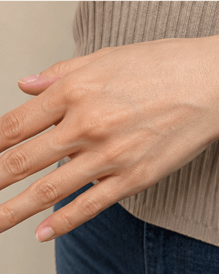 Hand Rejuvenation: before