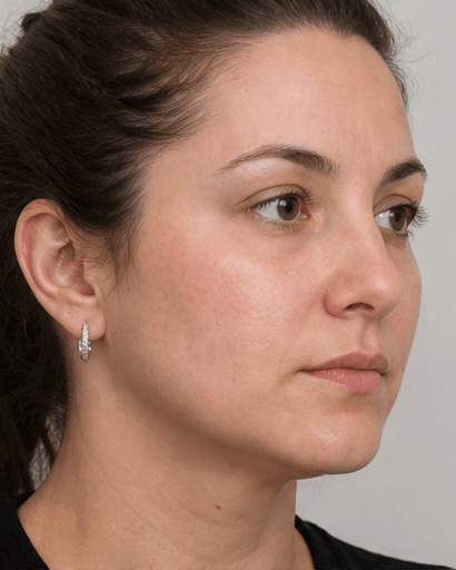 Jawline Contouring: after