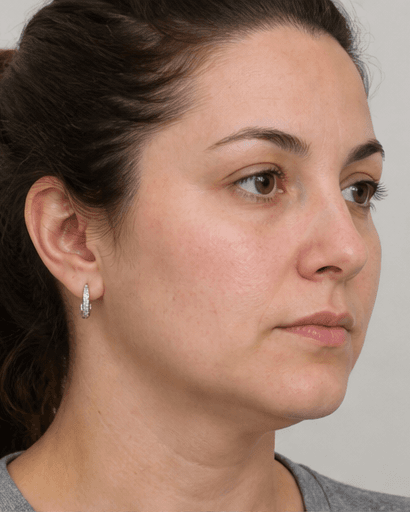 Jawline Contouring: before