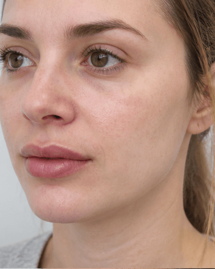 Lip Enhancement: after
