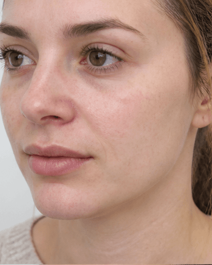 Lip Enhancement: before