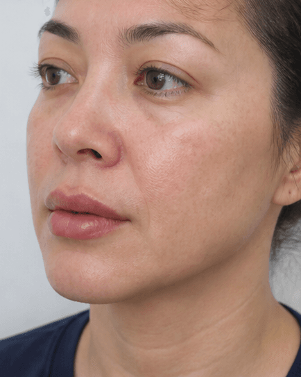 Lip Enhancement: after