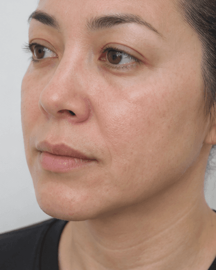 Lip Enhancement: before