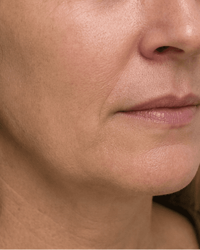 Smile Line Softening: after