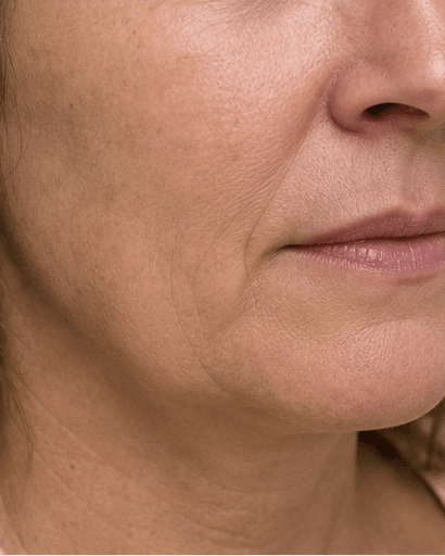 Smile Line Softening: before