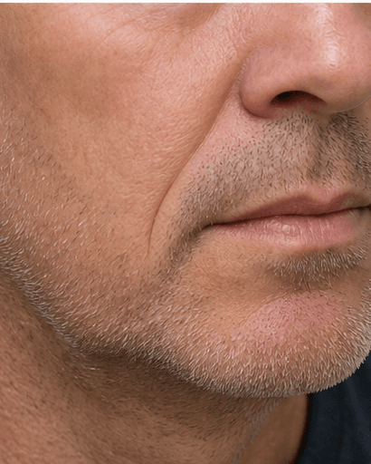 Smile Line Softening: before
