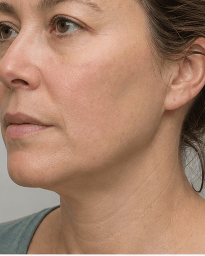 Collagen Stimulator: after