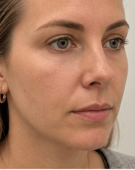 Tear Trough Filler: after