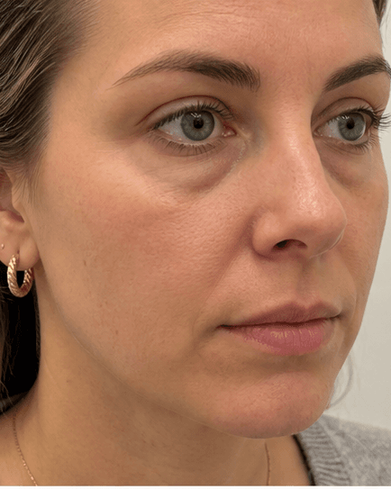 Tear Trough Filler: before