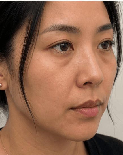 Tear Trough Filler: after