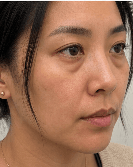 Tear Trough Filler: before