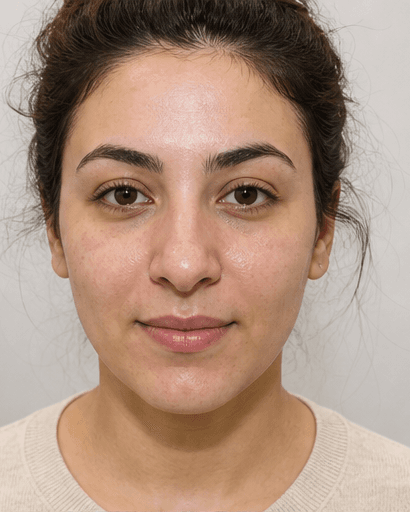 Carbon Laser Peel: after