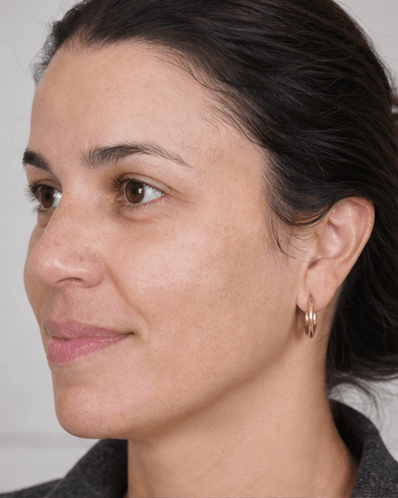 Medi-Facial (Hydra): after