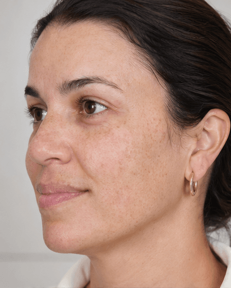 Medi-Facial (Hydra): before
