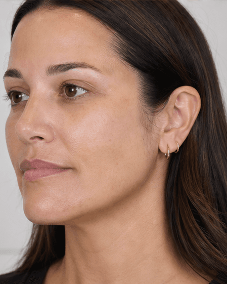 Medi-Facial (Hydra): after