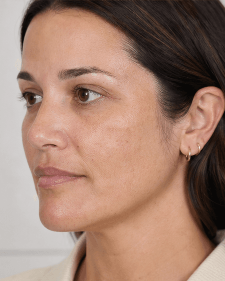 Medi-Facial (Hydra): before