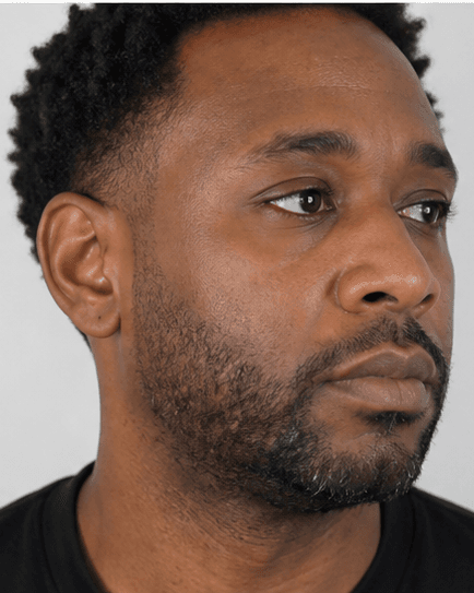 Beard Line Shaping: before
