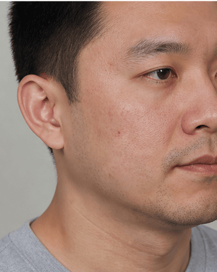 Diode Laser: before