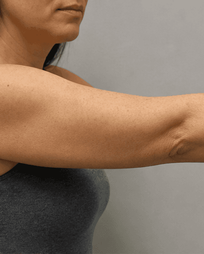 Full Arms: after